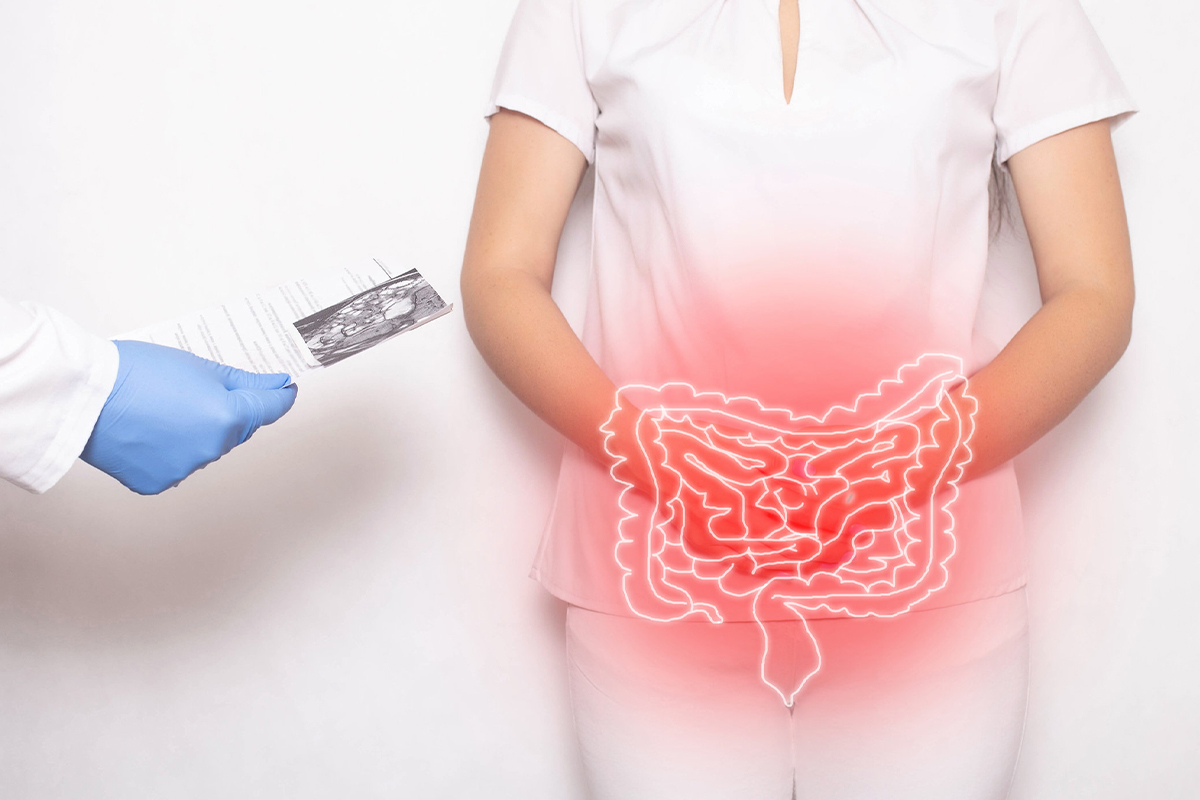 Was ist Colitis ulcerosa