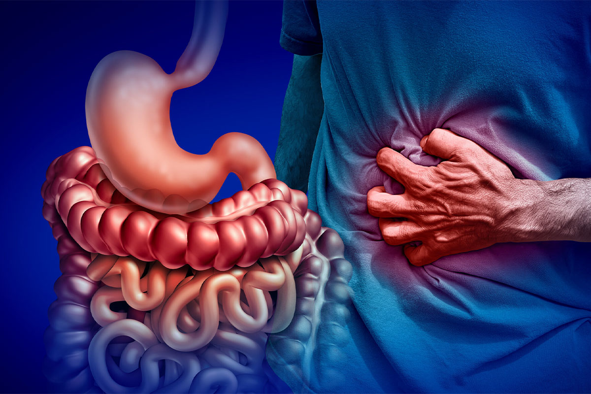 The Relationship Between Multiple Sclerosis and Leaky Gut Syndrome